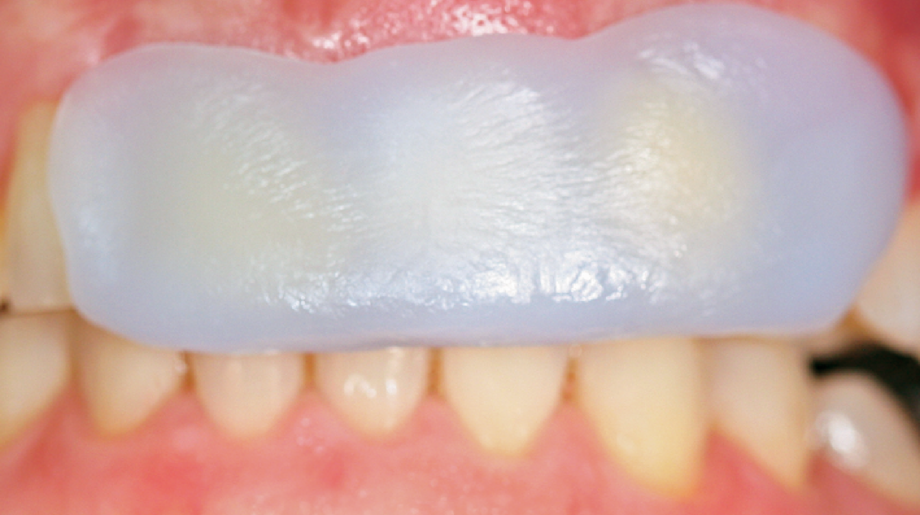 Soft tablet placed on teeth