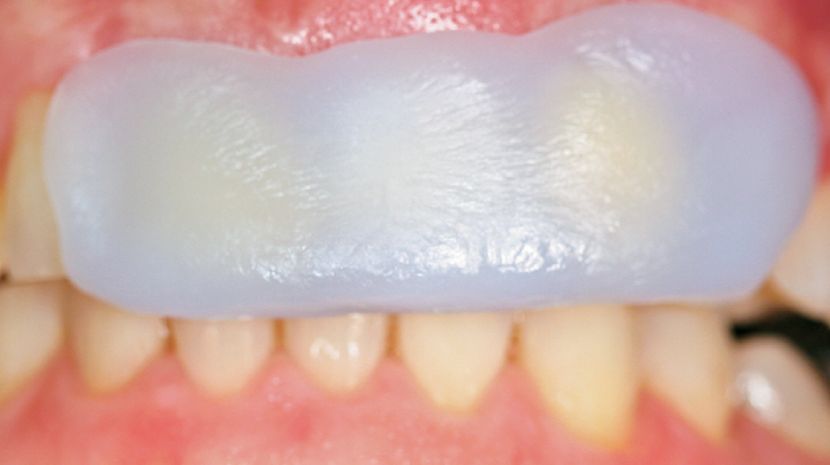 Soft tablet placed on teeth