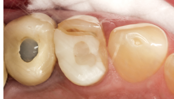 Defective row of teeth