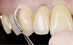 Applying mass to the tooth