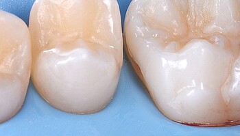 Smooth tooth surface