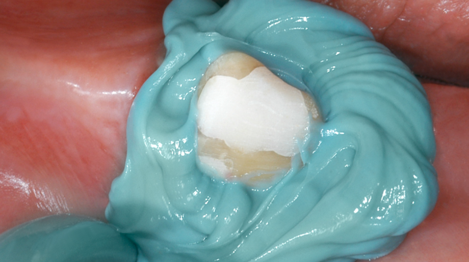 Application of Honigum Mono onto the prepared tooth
