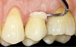 Applying mass to the tooth
