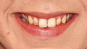 Discoloured anterior teeth before treatment