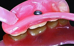 Prosthesis