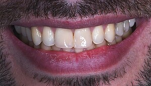 Anterior teeth after restoration
