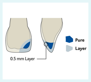 Drawing of a tooth with filling from the front and the side