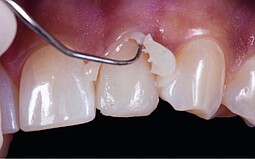 Removal of excess cement from the tooth