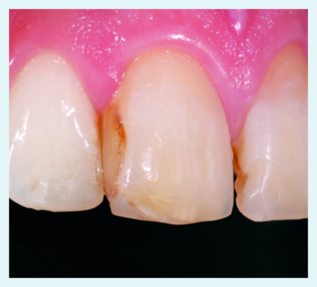 Row of teeth: initial situation